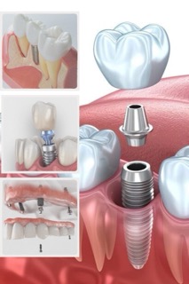 Implantologia dentale